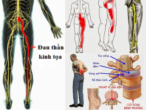 Giải pháp đẩy lùi đau thần kinh tọa cho người cao tuổi an toàn hiệu quả theo đông y