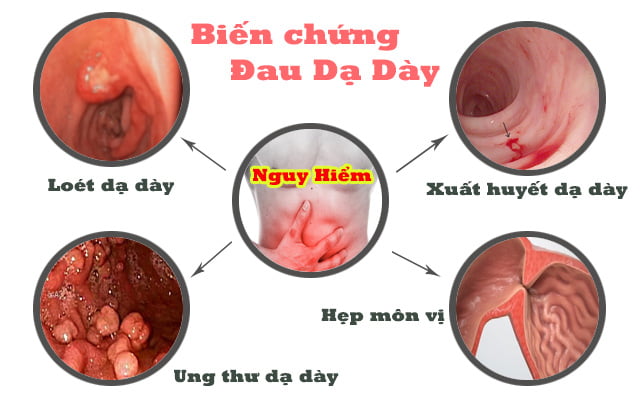 biến chứng đau dạ dày
