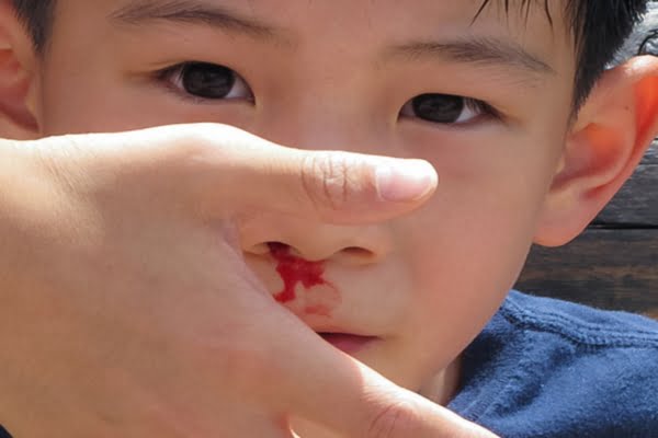 Chấm dứt viêm mũi dị ứng