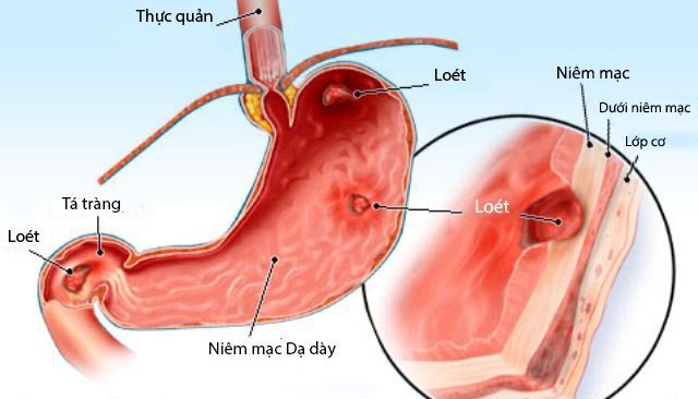 Viêm loét dạ dày tá tràng giờ đây chỉ là dĩ vãng nếu bạn áp dụng theo cách sau