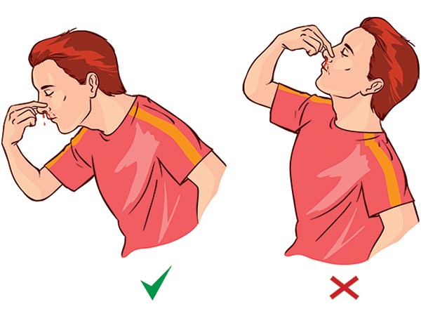 xử lý khi chảy máu cam