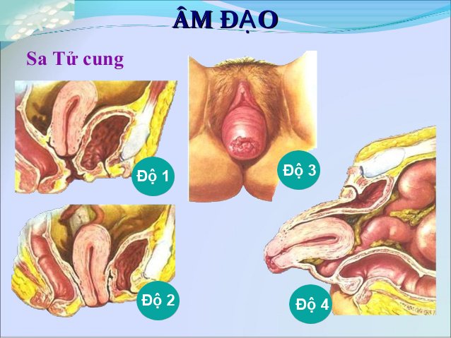 Phương pháp chữa sa tử cung triệt để nhất