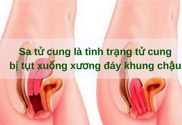 sa tử cung