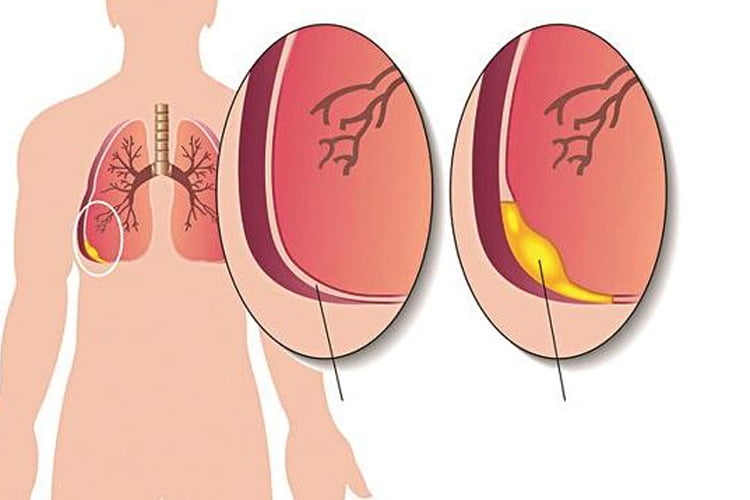 Bệnh tràn dịch màng phổi là gì? Tại sao phải cần đến Đông Y để xử lý