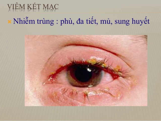 Viêm kết mạc dị ứng làm cách nào để khỏi bệnh?