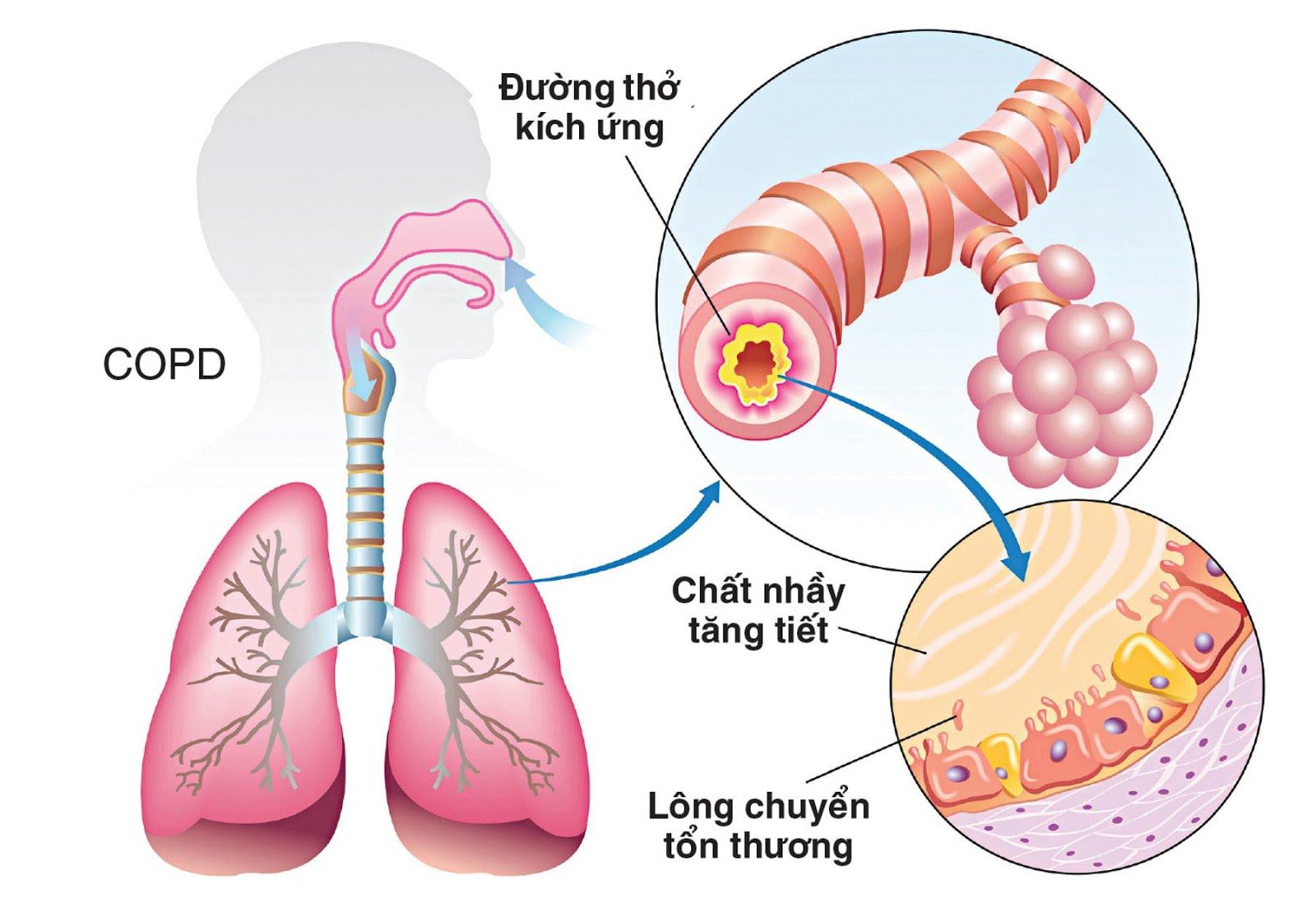 Giải pháp điều trị phổi tắc nghẽn mãn tính (COPD) tốt nhất hiện nay