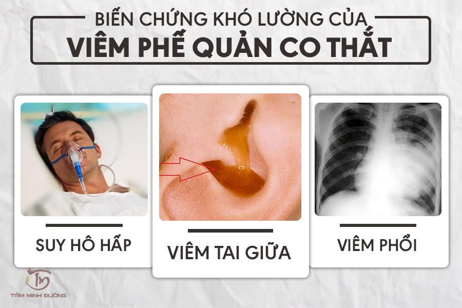 biến chứng của Viêm phế quản co thắt thể hen