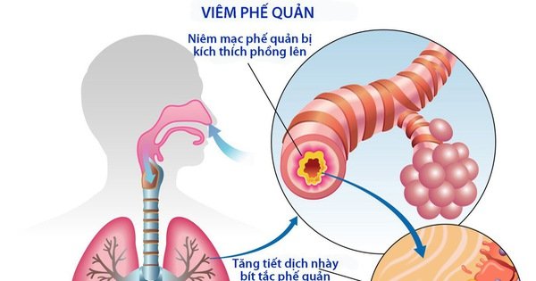 Phế quản bị viêm