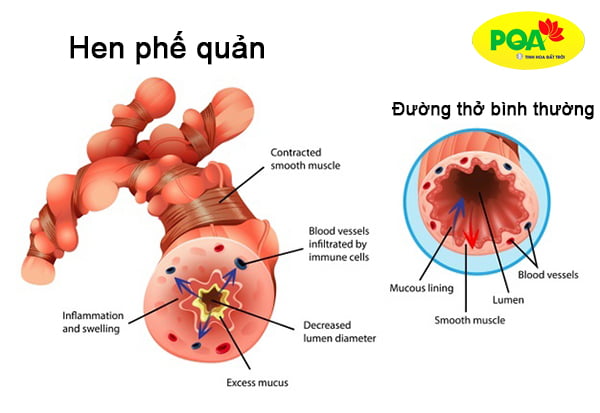 Trẻ em bị hen phế quản do chất nhầy nhiều gây tắc ống thở